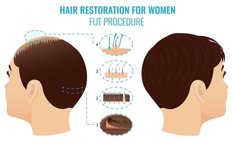 FUT hair restoration