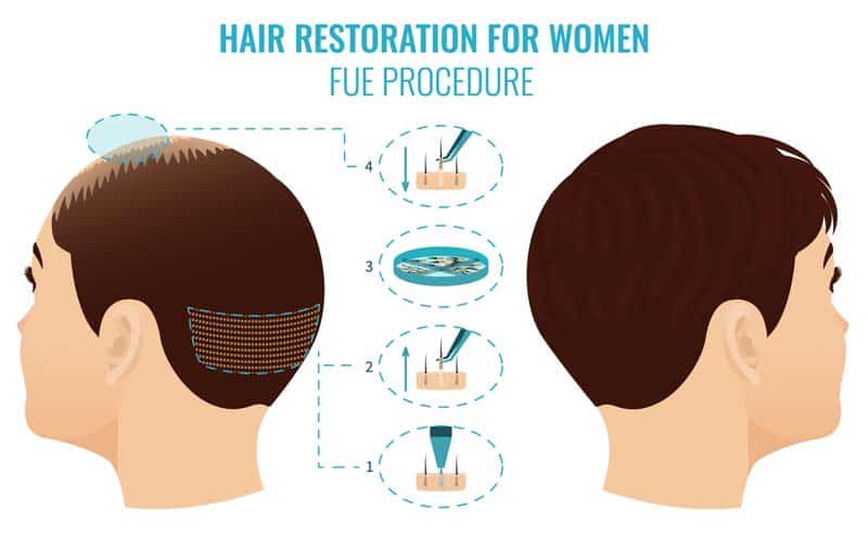 FUE hair restoration