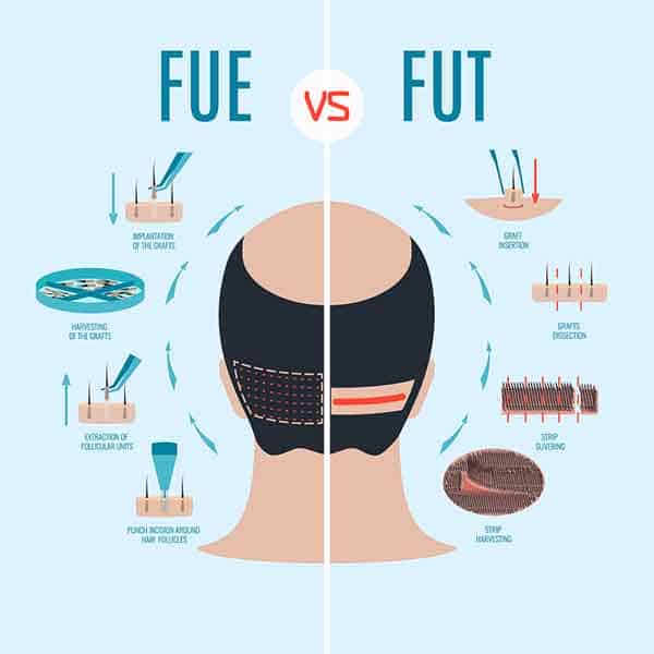 FUE vs. FUT hair transplant