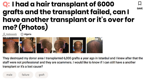 hair transplant goes wrong